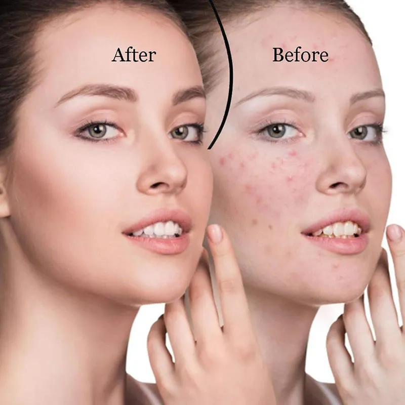 Rechargeable Cleaner Face Blackhead Remover